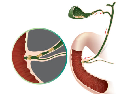 La Cholécystectomie : ablation de la vésicule biliaire à Pau - Centre ...