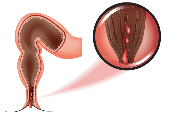 Fissure anale à Pau - Centre de Chirurgie digestive et de l'Obésité