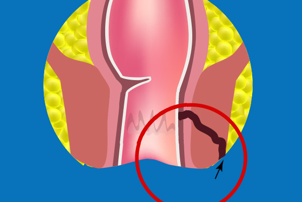 Fistule anale à Pau - Centre de Chirurgie digestive et de l'Obésité