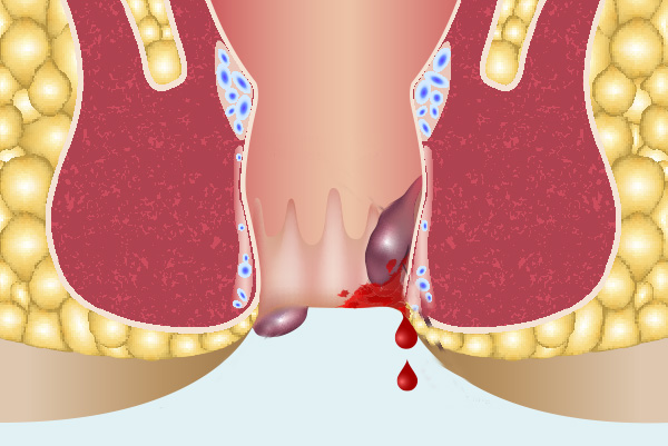 Hémorroïdes à Pau - Centre de Chirurgie digestive et de l'Obésité