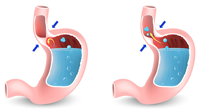 Reflux Gastro Oesophagien à Pau